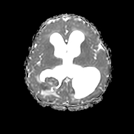 Choroid Plexus Tumor | Image | Radiopaedia.org