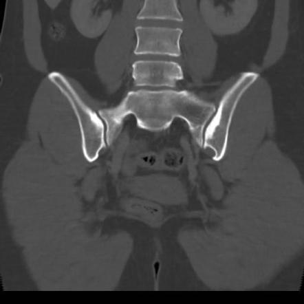 Sacroiliitis Radiology Reference Article Radiopaedia Org