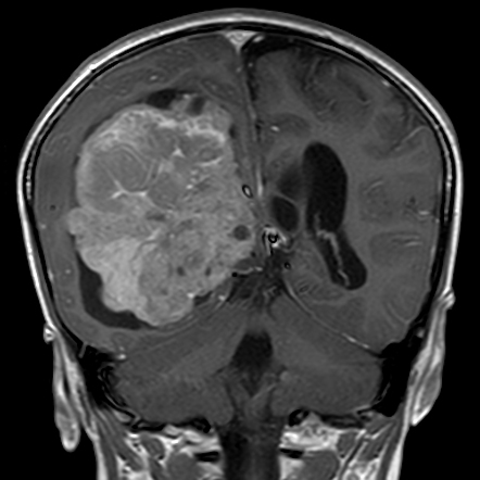 Choroid Plexus Carcinoma | Image | Radiopaedia.org