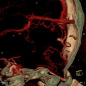 Dural arteriovenous fistula | Radiology Reference Article | Radiopaedia.org