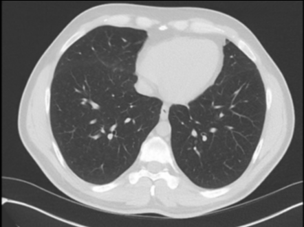 Respiratory bronchiolitis - interstitial lung disease (RB-ILD) | Image ...