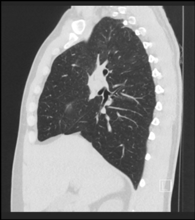 Respiratory bronchiolitis - interstitial lung disease (RB-ILD) | Image ...