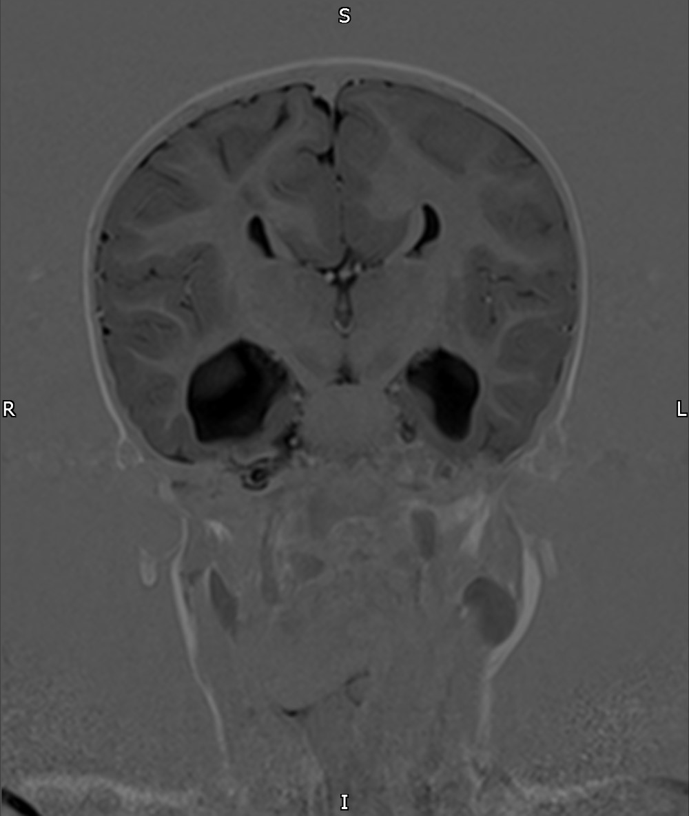 Corpus Callosum Agenesis Image