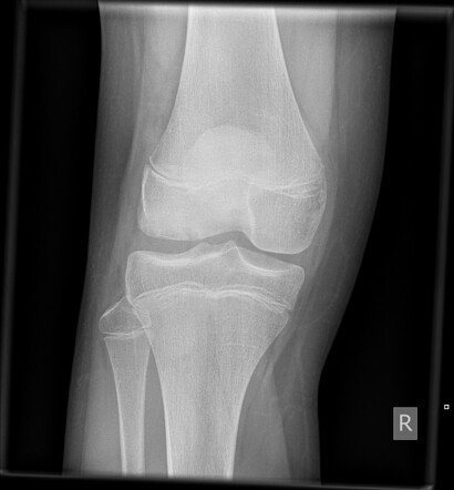 Osteochondral defect of knee | Radiology Case | Radiopaedia.org