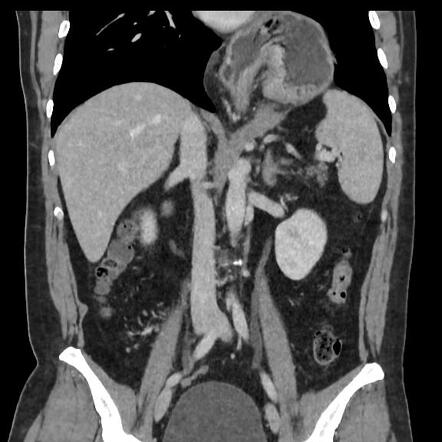 Mixed hiatal hernia with organoaxial gastric volvulus | Radiology Case ...