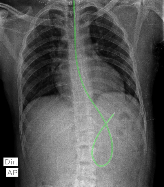 Malpositioned Nasogastric Tube | Image | Radiopaedia.org