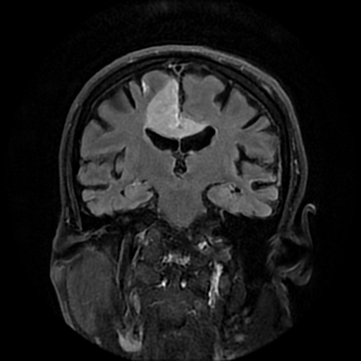 Sneddon syndrome | Image | Radiopaedia.org