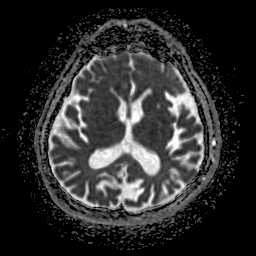 Sneddon syndrome | Image | Radiopaedia.org