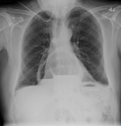 Gastric hiatus hernia | Radiology Case | Radiopaedia.org