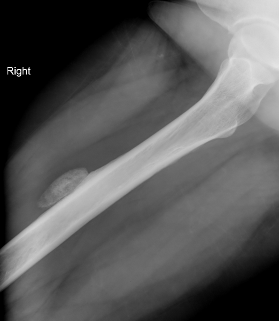 Myositis ossificans | Radiology Reference Article | Radiopaedia.org