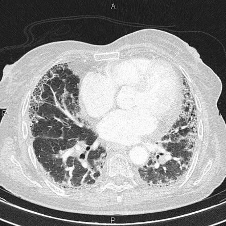 Post COVID pulmonary fibrosis | Radiology Case | Radiopaedia.org