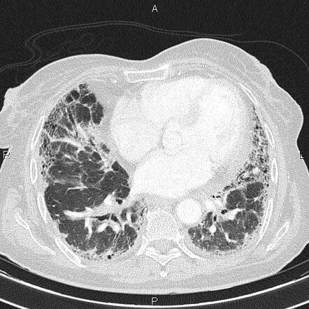 Pulmonary fibrosis | Radiology Reference Article | Radiopaedia.org