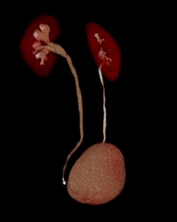 Obstructive uropathy | Radiology Case | Radiopaedia.org