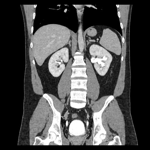 Obstructive Uropathy | Image | Radiopaedia.org