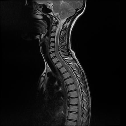 Myelomeningocele and tethered cord | Image | Radiopaedia.org