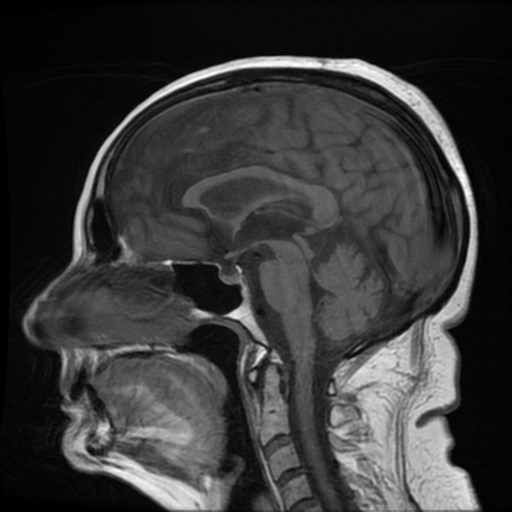 Inflammatory Cerebral Amyloid Angiopathy | Image | Radiopaedia.org