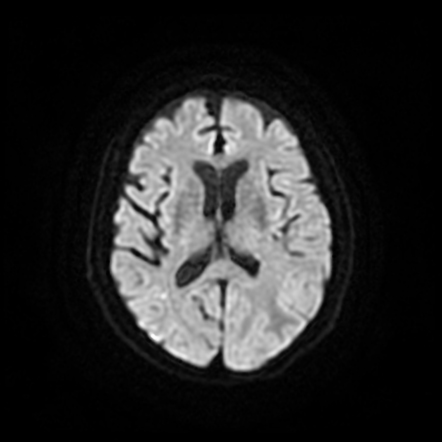 Inflammatory cerebral amyloid angiopathy | Image | Radiopaedia.org