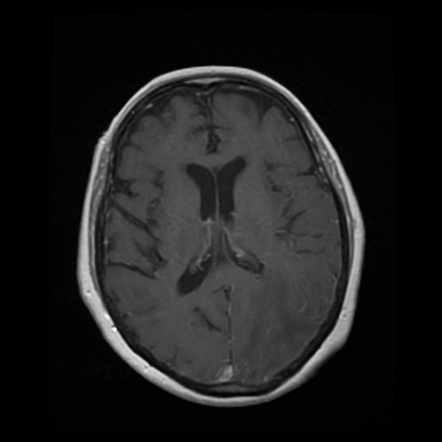 Inflammatory cerebral amyloid angiopathy | Image | Radiopaedia.org