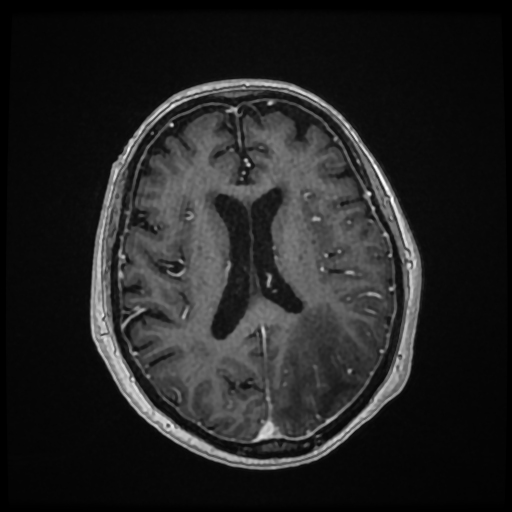 Inflammatory Cerebral Amyloid Angiopathy | Image | Radiopaedia.org