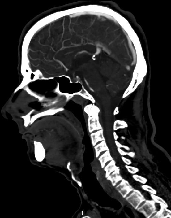 Vertebrobasilar artery occlusion - diagnosis and treatment | Image ...