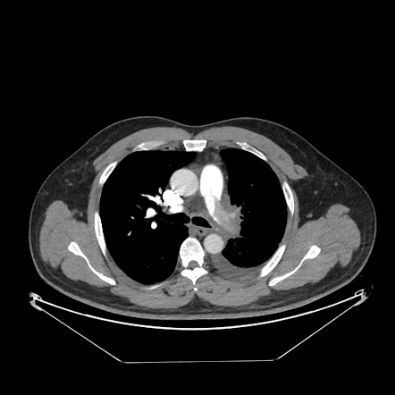 Pulmonary vein thrombosis | Radiology Reference Article | Radiopaedia.org