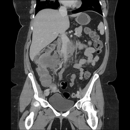 Colorectal carcinoma with sarcomatoid component | Radiology Case ...