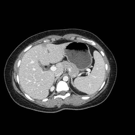 Hepatic pseudolesion near falciform ligament | Radiology Case ...