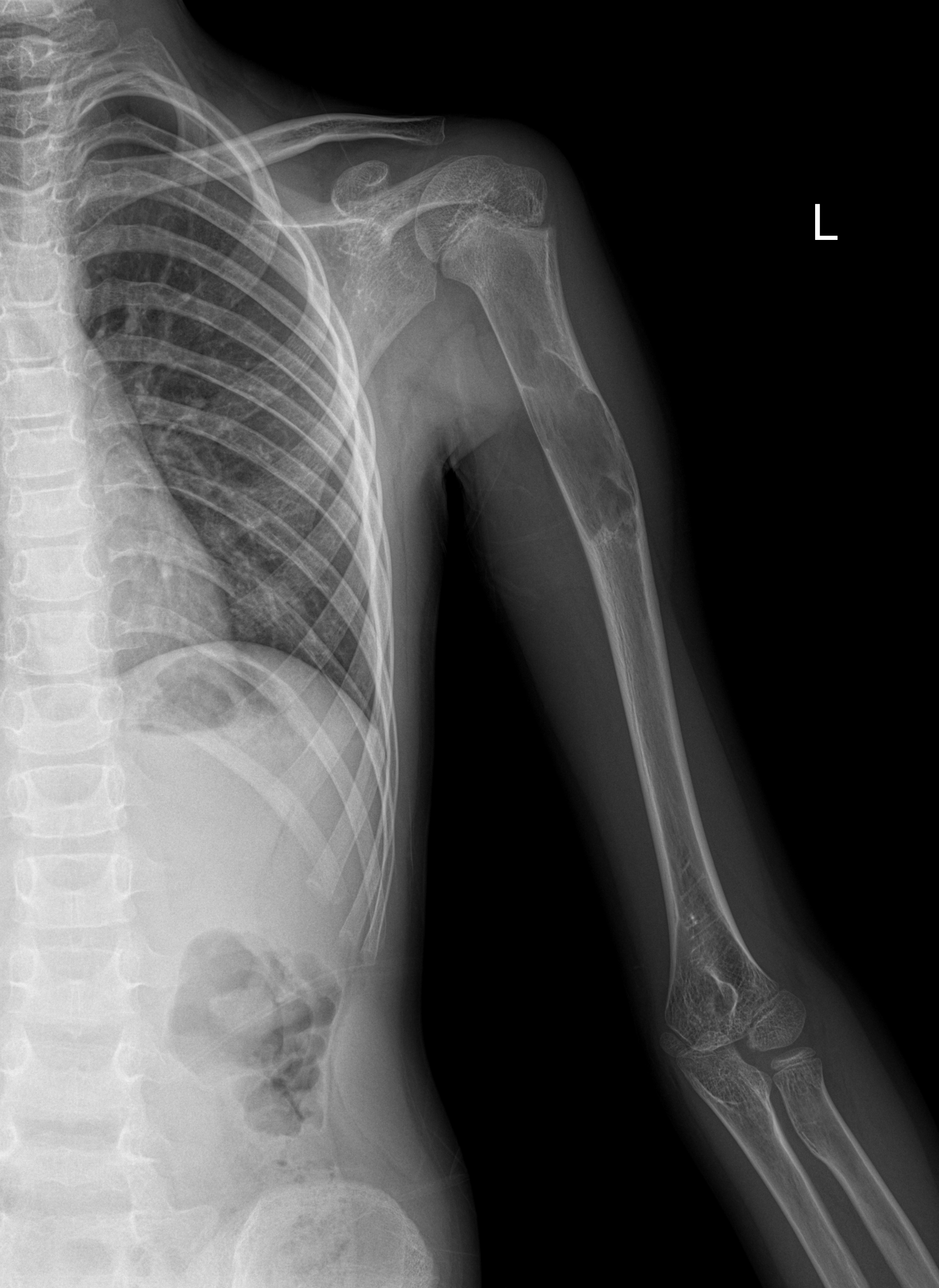 Unicameral Bone Cyst Humerus Image