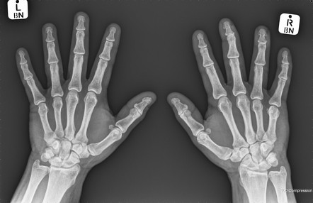 Mallet fingers | Radiology Case | Radiopaedia.org