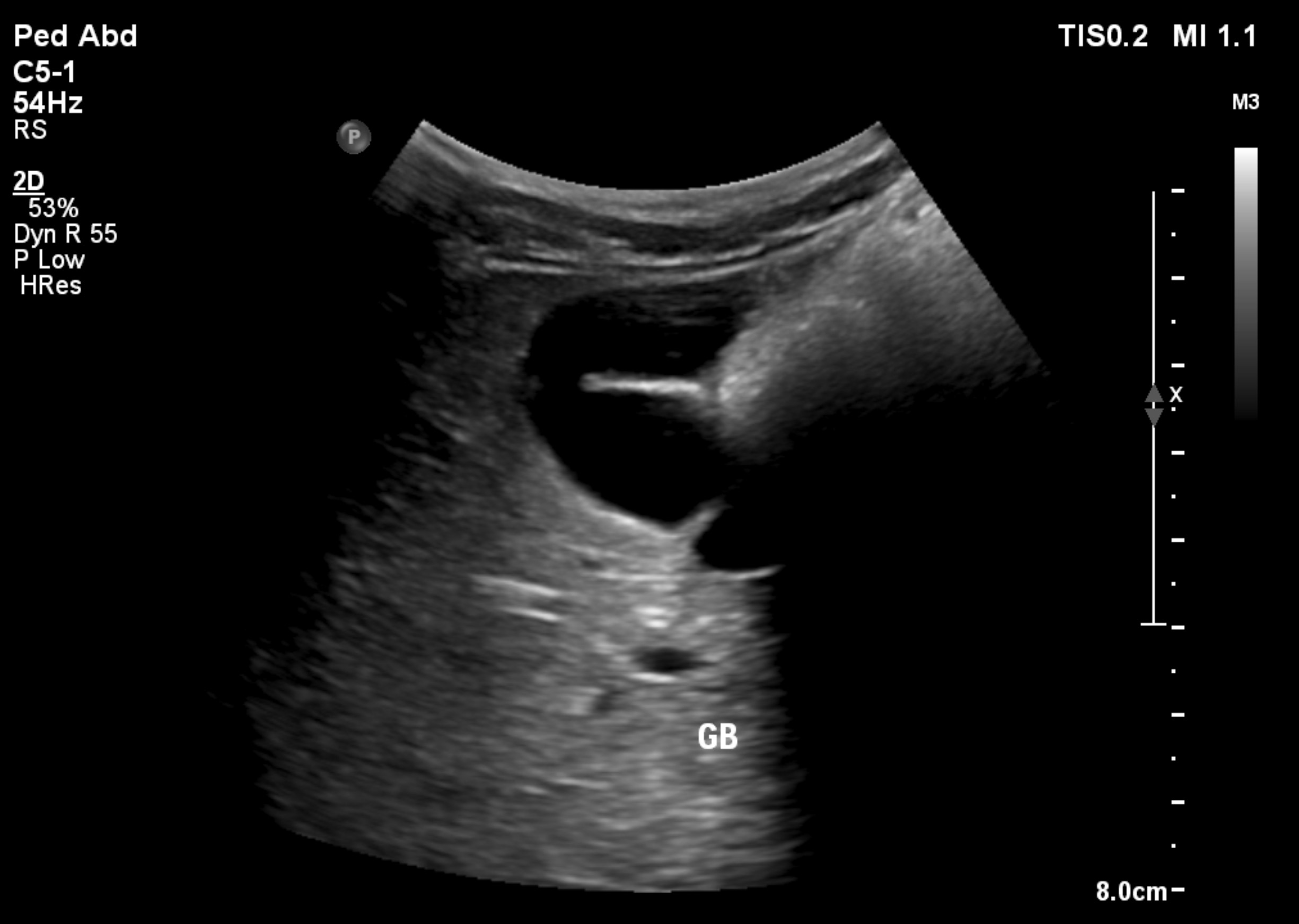 Gallbladder folds | Image | Radiopaedia.org