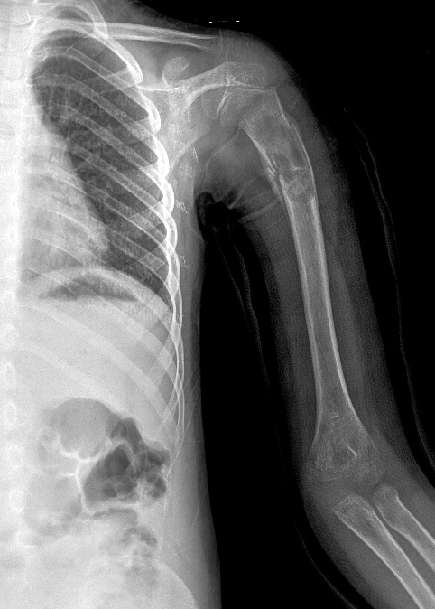 Unicameral bone cyst - humerus | Image | Radiopaedia.org