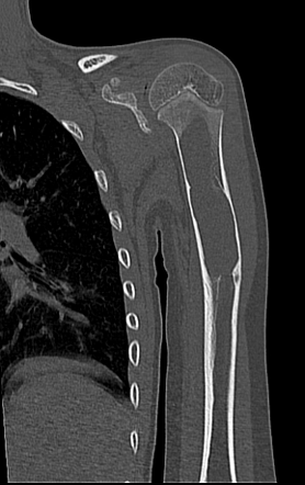 Unicameral bone cyst - humerus | Radiology Case | Radiopaedia.org