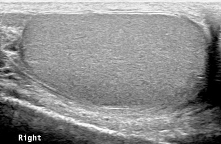 Intrascrotal extratesticular epidermoid cyst | Image | Radiopaedia.org