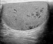 Extratesticular cystic lesions (differential) | Radiology Reference ...