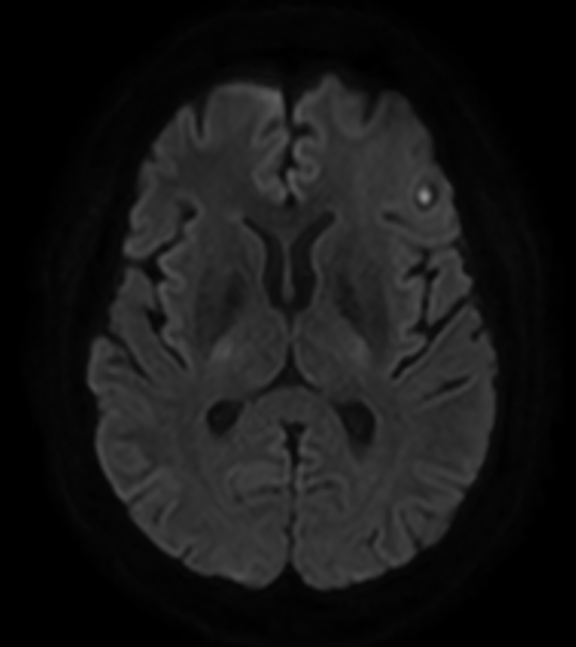 Nocardia brain abscesses | Image | Radiopaedia.org