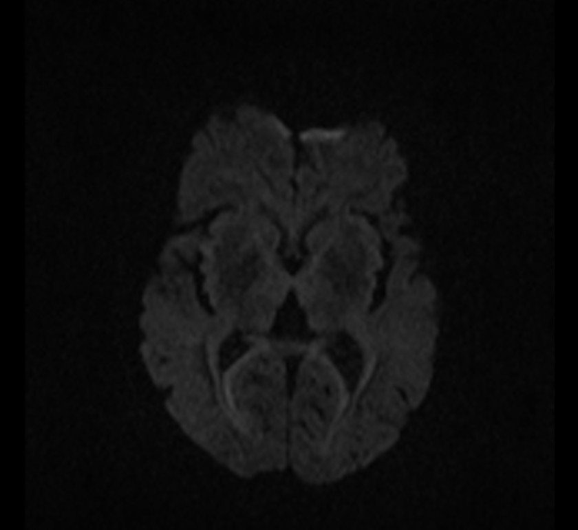 Oculomotor Nerve Palsy | Image | Radiopaedia.org