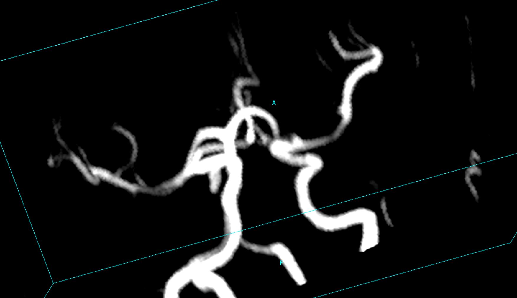 Oculomotor Nerve Palsy | Image | Radiopaedia.org