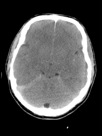 Global hypoxic-ischemic cerebral injury | Radiology Case | Radiopaedia.org