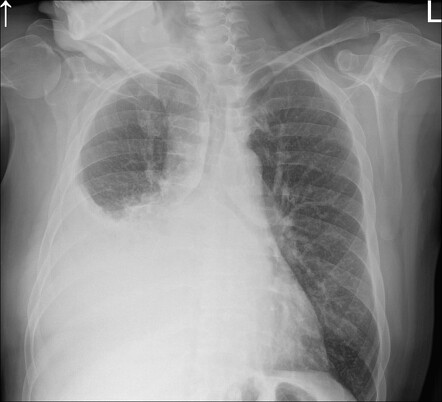 Small cell lung cancer | Radiology Case | Radiopaedia.org