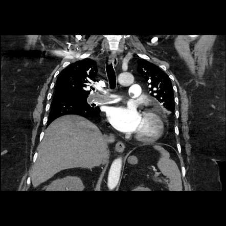 Saddle pulmonary embolism | Image | Radiopaedia.org