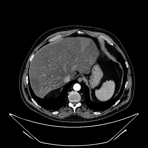 Geographic Pattern Hepatic Steatosis Image