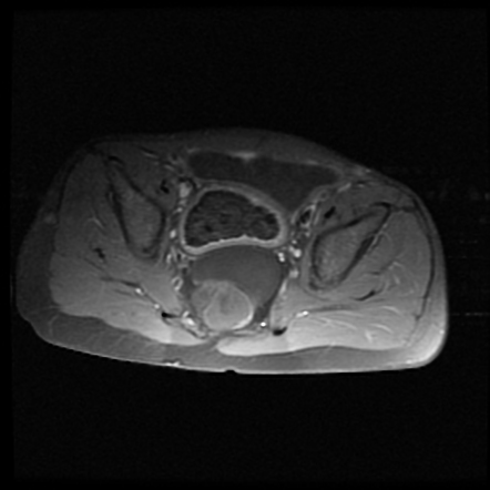 Currarino syndrome | Image | Radiopaedia.org