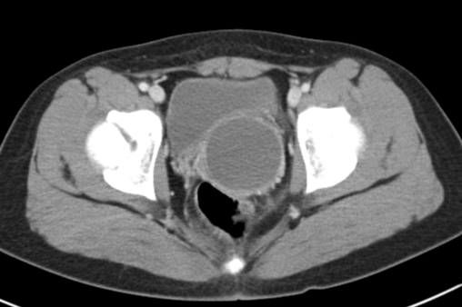 OHVIRA syndrome | Image | Radiopaedia.org