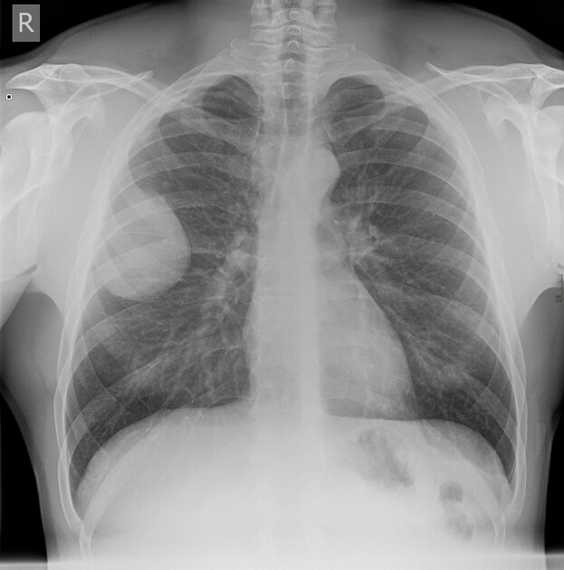 Pleural Lipoma 