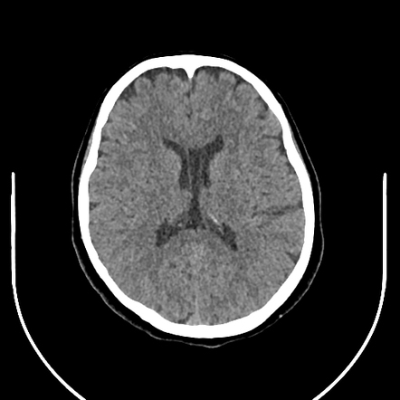 Cavum vergae | Radiology Case | Radiopaedia.org