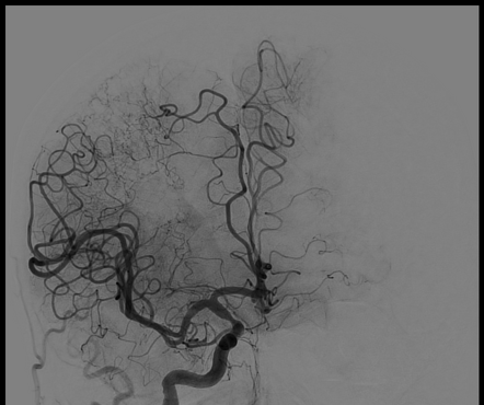 Sneddon syndrome | Radiology Case | Radiopaedia.org