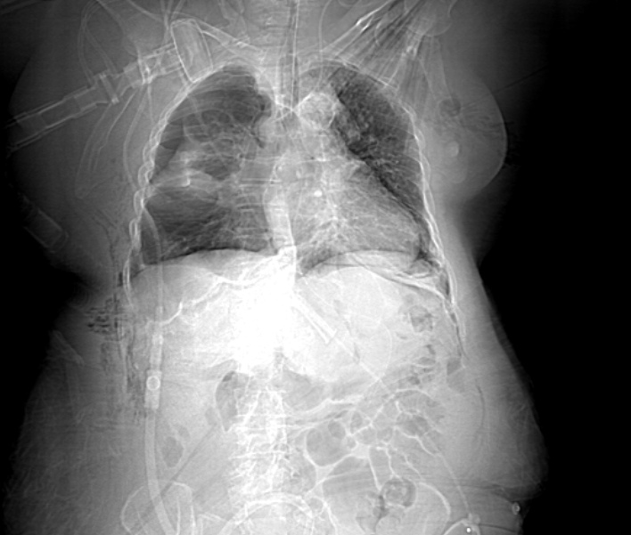 Barotrauma due to mechanical ventilation | Image | Radiopaedia.org