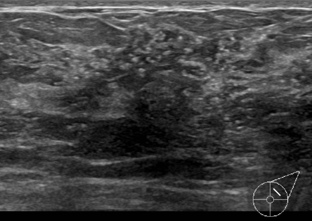 Ductal Carcinoma In Situ Dcis Image 1710