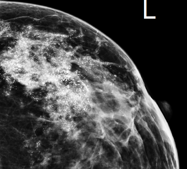 Ductal Carcinoma In Situ (DCIS) | Image | Radiopaedia.org