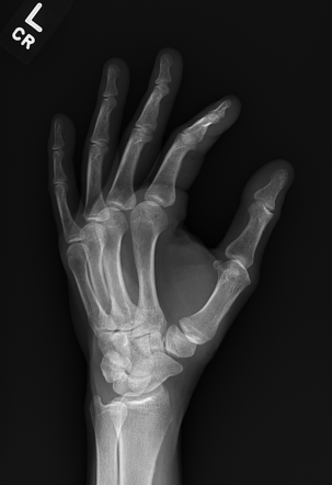 Bennett fracture | Image | Radiopaedia.org